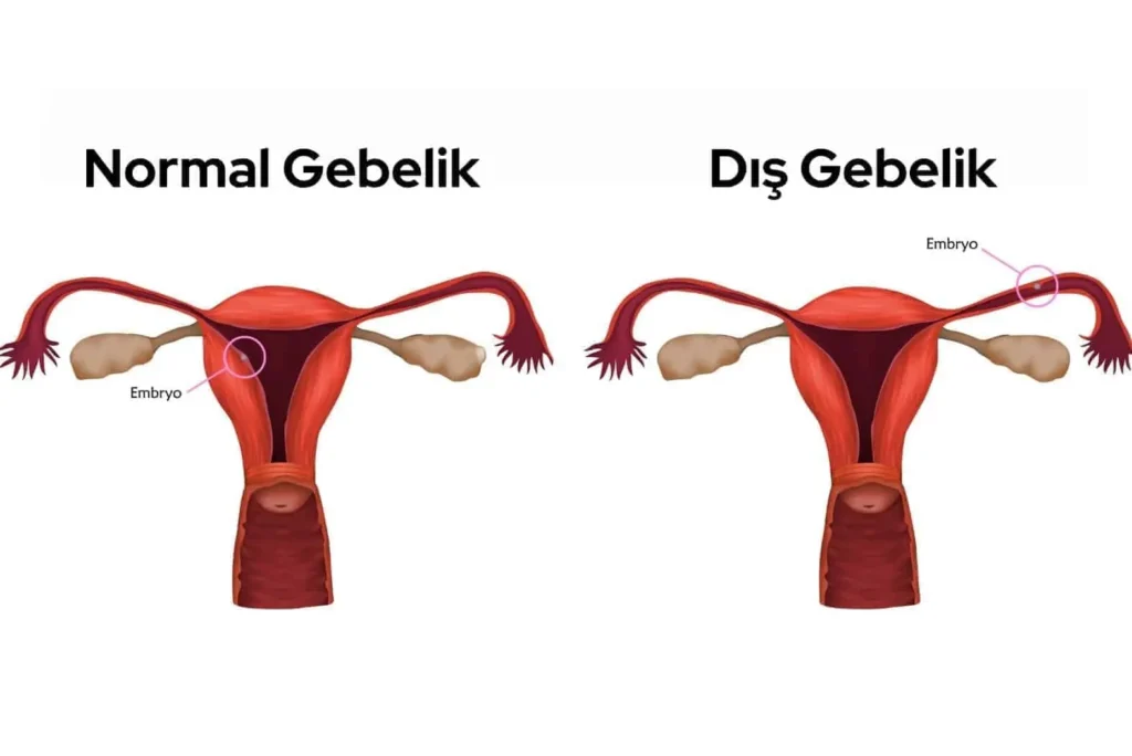 dis-gebelik
