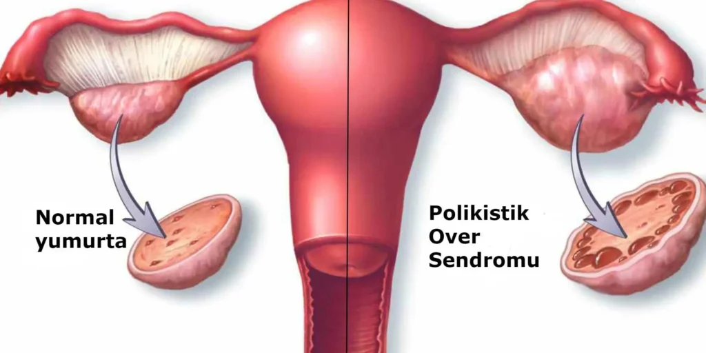 pcos-ilkay